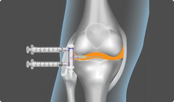 Successful-treatment-with-A-Tap